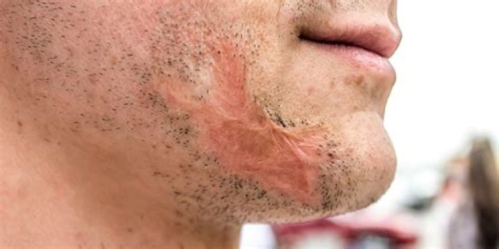 Can accident scars be removed?