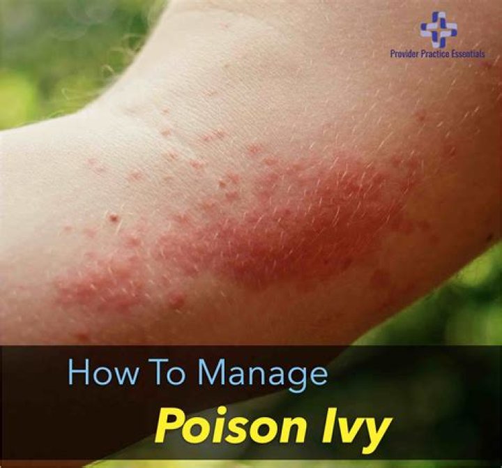Can poison ivy spread from scratching?