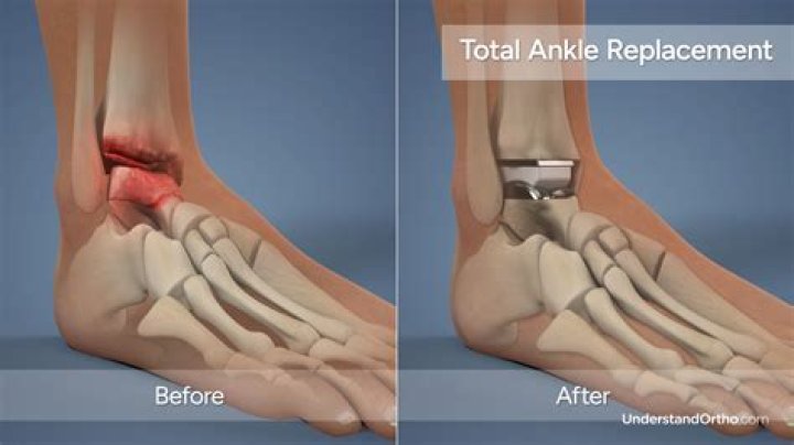 How long after ankle surgery Can you swim?