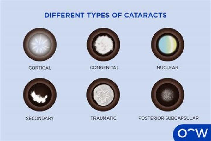 What are the different types of cataracts?