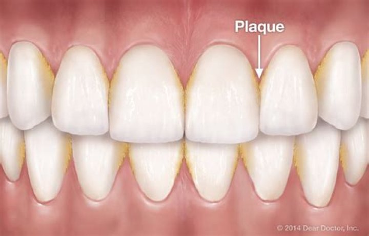 What causes plaque build up on your teeth?