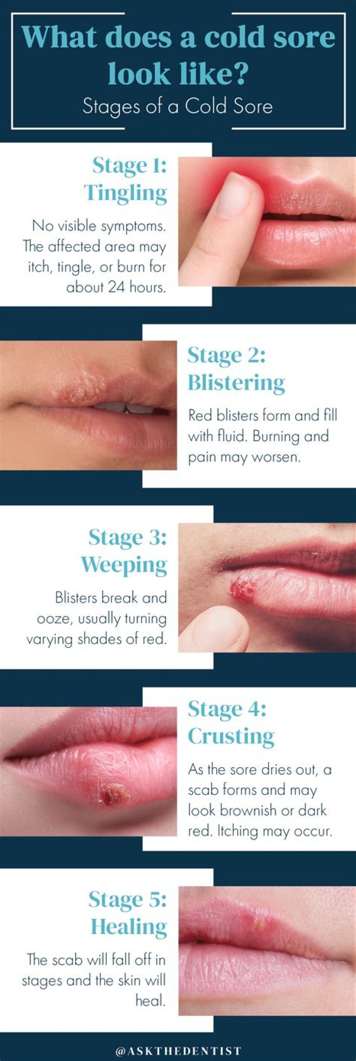 What happens if a cold sore scab falls off?